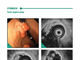 Radial endosonography atlas endoscopic and ultrasound interpretation. Vladimir Romanov